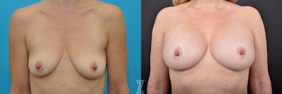 Breast Augmentation With a Breast Lift Before & After Gallery - Patient 132791085 - Image 1
