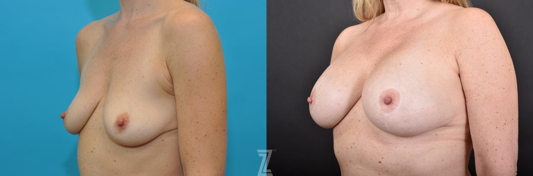 Breast Augmentation With a Breast Lift Before & After Gallery - Patient 132791085 - Image 2