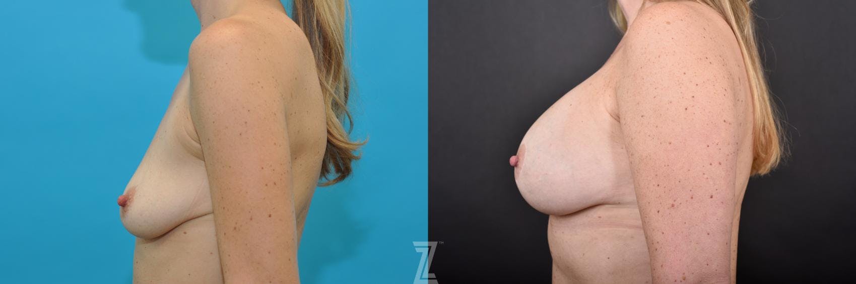 Breast Augmentation With a Breast Lift Before & After Gallery - Patient 132791085 - Image 3