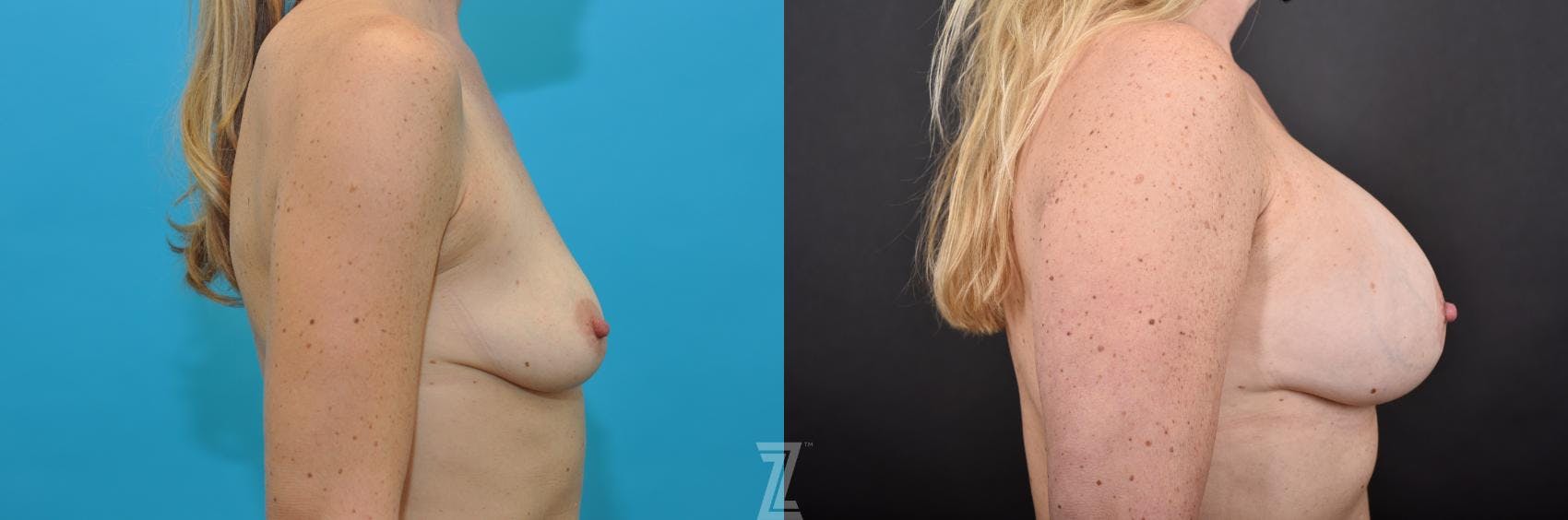 Breast Augmentation With a Breast Lift Before & After Gallery - Patient 132791085 - Image 5