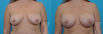 Breast Augmentation With a Breast Lift Before & After Gallery - Patient 132791088 - Image 1