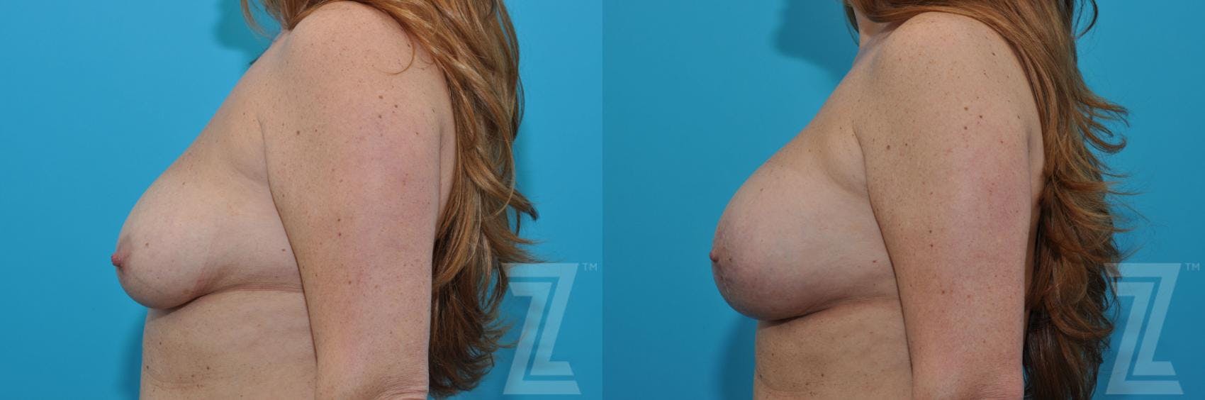 Breast Augmentation With a Breast Lift Before & After Gallery - Patient 132791088 - Image 3