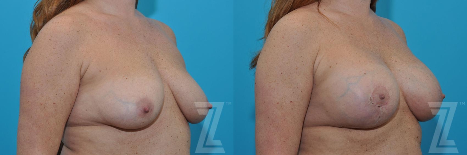 Austin Breast Augmentation With a Breast Lift Before & After Gallery - Patient 132791088 - Image 4 - The Piazza Center