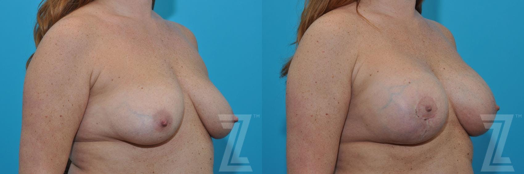 Breast Augmentation With a Breast Lift Before & After Gallery - Patient 132791088 - Image 4