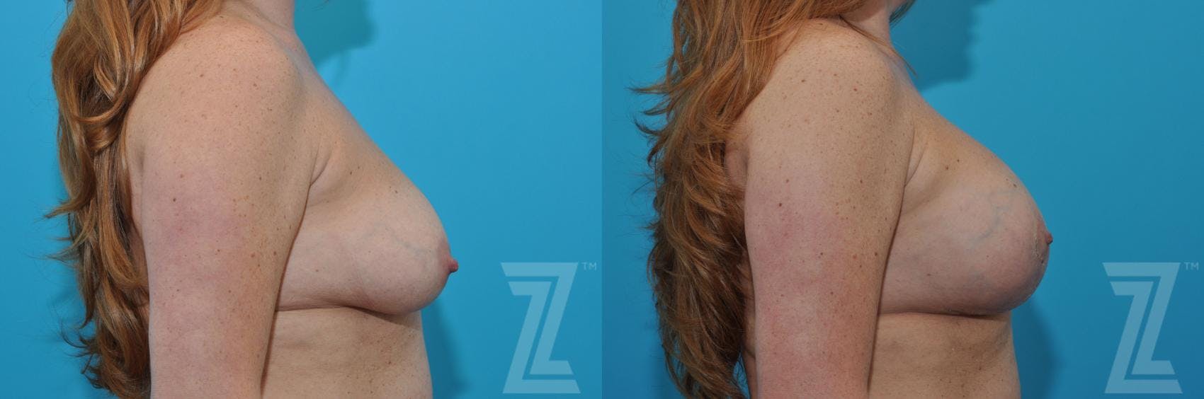 Breast Augmentation With a Breast Lift Before & After Gallery - Patient 132791088 - Image 5