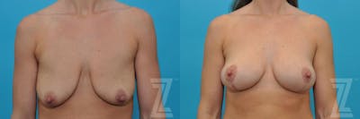 Austin Breast Augmentation With a Breast Lift Before & After Gallery - Patient 132791091 - Image 1 - The Piazza Center