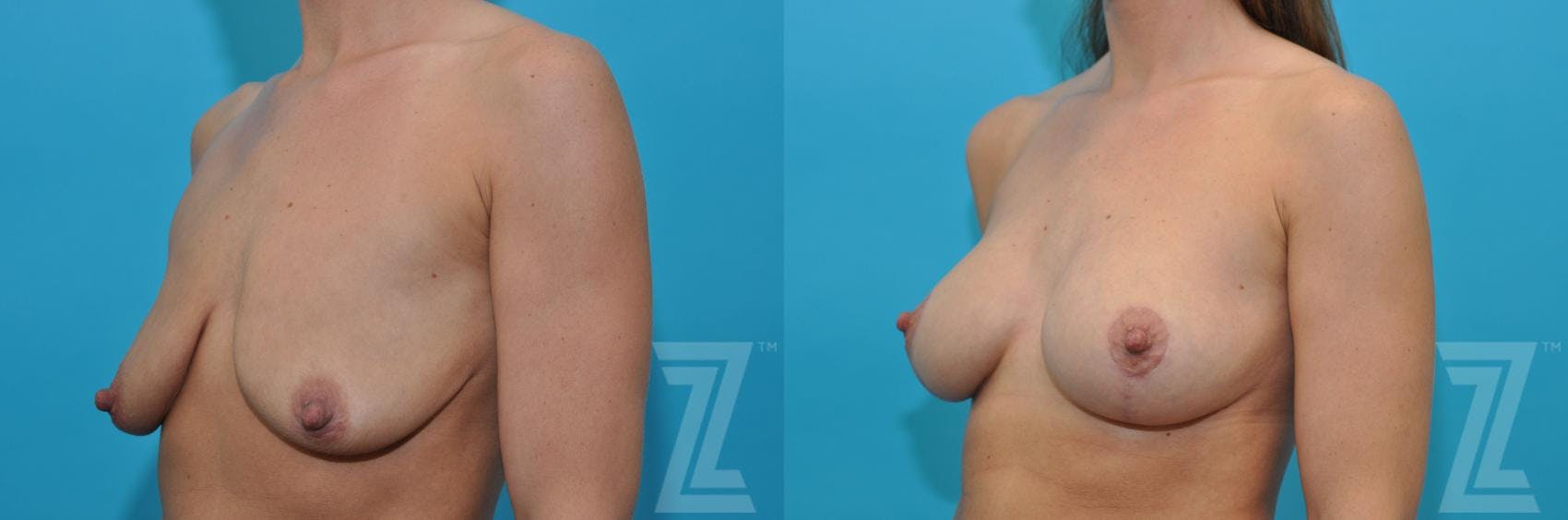 Breast Augmentation With a Breast Lift Before & After Gallery - Patient 132791091 - Image 2