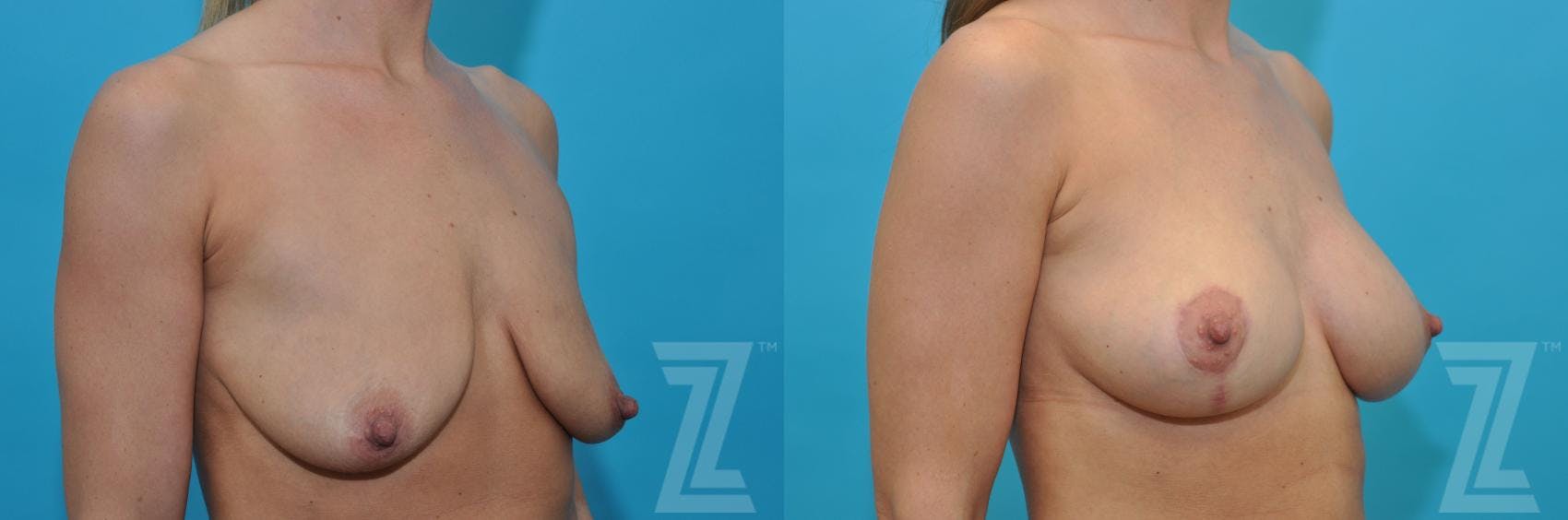 Breast Augmentation With a Breast Lift Before & After Gallery - Patient 132791091 - Image 4