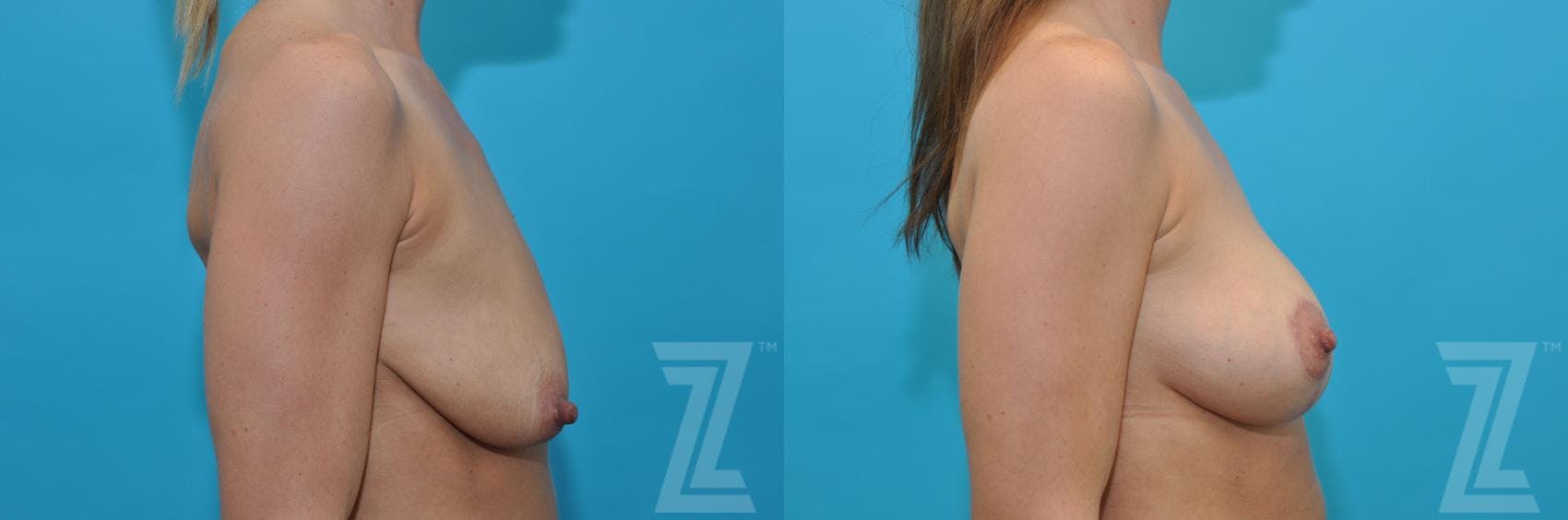 Breast Augmentation With a Breast Lift Before & After Gallery - Patient 132791091 - Image 5