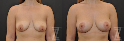Breast Augmentation With a Breast Lift Before & After Gallery - Patient 132791094 - Image 1