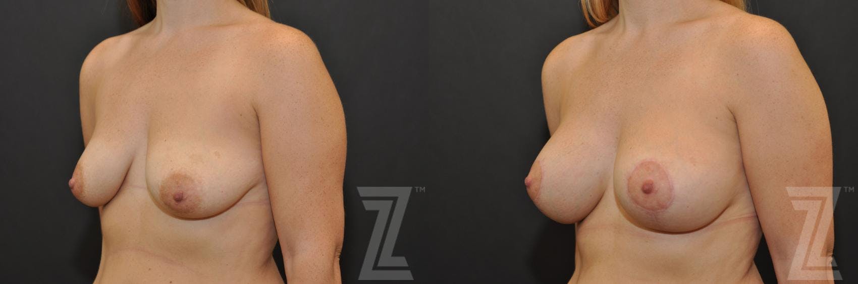 Breast Augmentation With a Breast Lift Before & After Gallery - Patient 132791094 - Image 2