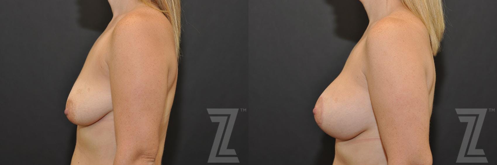Breast Augmentation With a Breast Lift Before & After Gallery - Patient 132791094 - Image 3