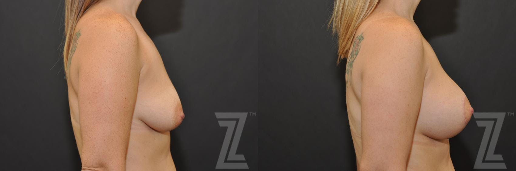 Breast Augmentation With a Breast Lift Before & After Gallery - Patient 132791094 - Image 5
