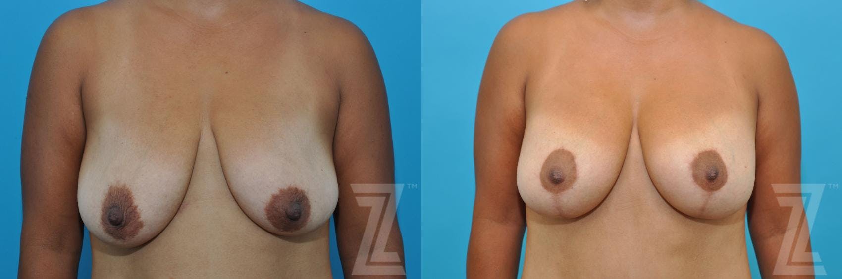 Breast Augmentation With a Breast Lift Before & After Gallery - Patient 132791096 - Image 1
