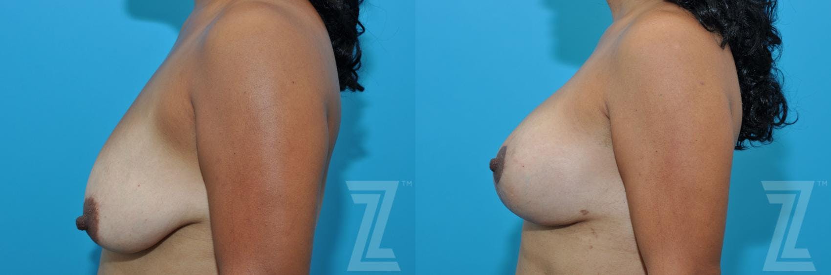 Breast Augmentation With a Breast Lift Before & After Gallery - Patient 132791096 - Image 3