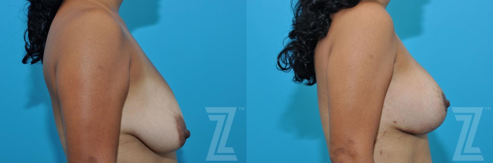 Breast Augmentation With a Breast Lift Before & After Gallery - Patient 132791096 - Image 5