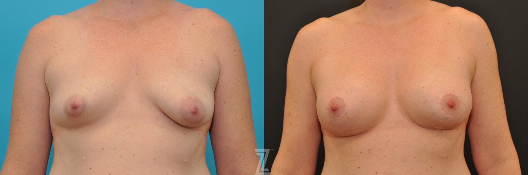 Breast Augmentation With a Breast Lift Before & After Gallery - Patient 132791097 - Image 1