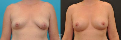 Austin Breast Augmentation With a Breast Lift Before & After Gallery - Patient 132791097 - Image 1 - The Piazza Center