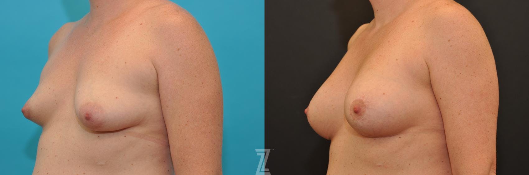 Breast Augmentation With a Breast Lift Before & After Gallery - Patient 132791097 - Image 2