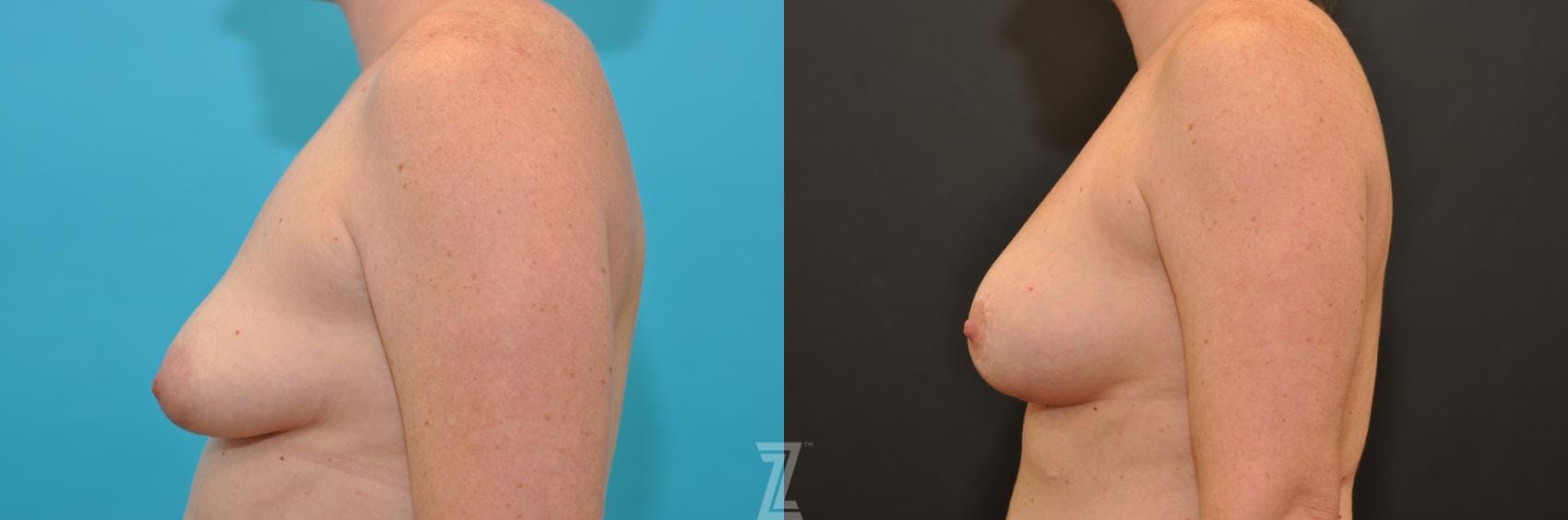 Breast Augmentation With a Breast Lift Before & After Gallery - Patient 132791097 - Image 3