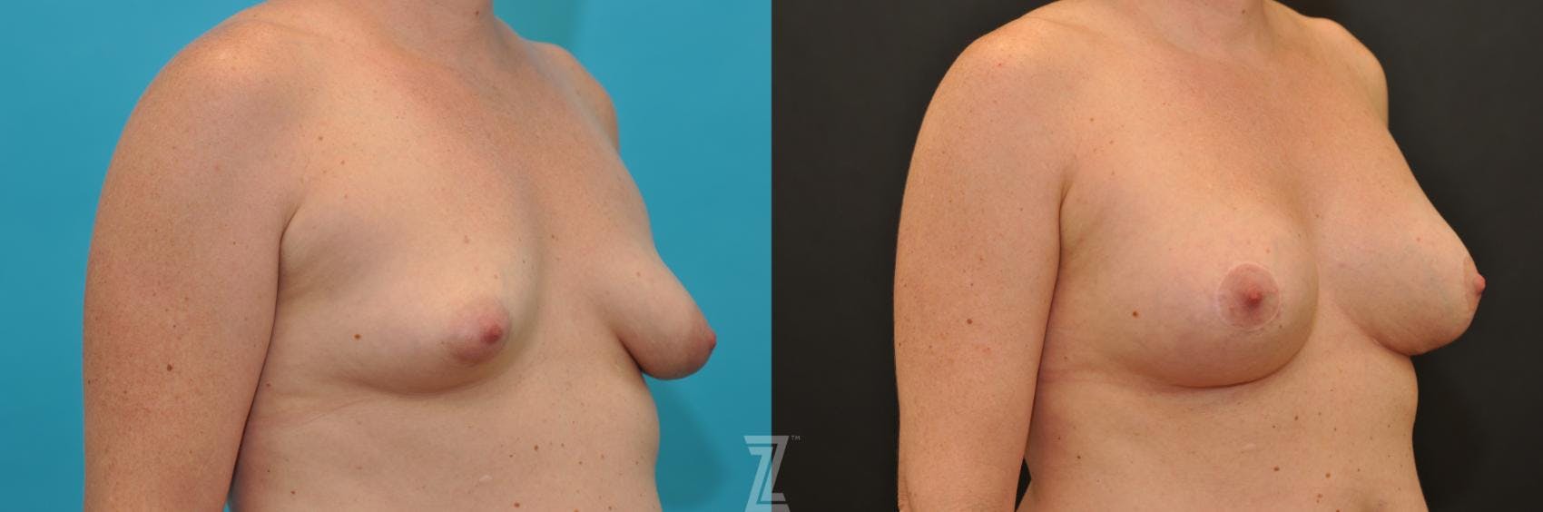 Breast Augmentation With a Breast Lift Before & After Gallery - Patient 132791097 - Image 4