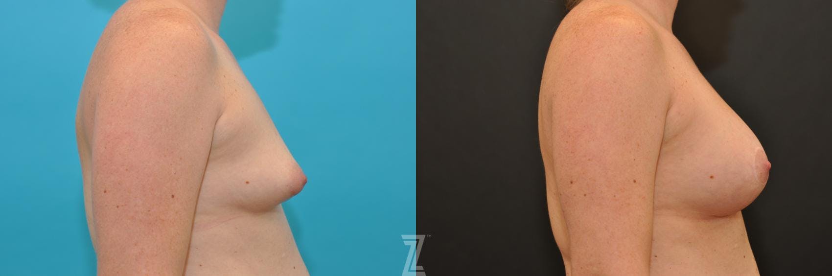 Breast Augmentation With a Breast Lift Before & After Gallery - Patient 132791097 - Image 5