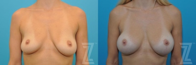 Breast Augmentation With a Breast Lift Before & After Gallery - Patient 132791105 - Image 1