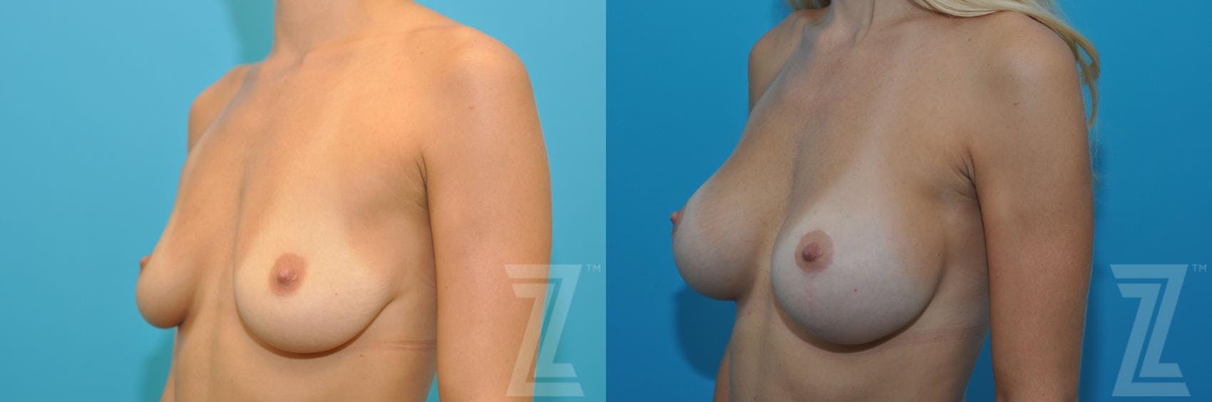 Breast Augmentation With a Breast Lift Before & After Gallery - Patient 132791105 - Image 2