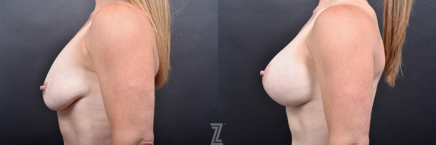 Breast Augmentation With a Breast Lift Before & After Gallery - Patient 132791106 - Image 3