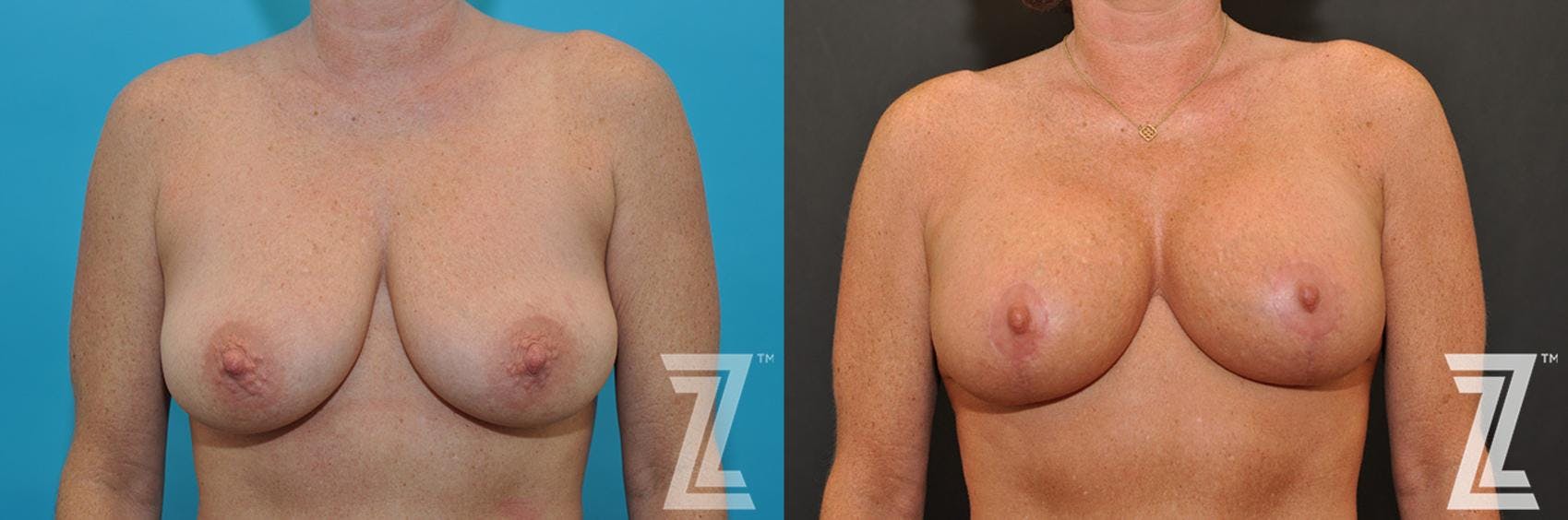 Breast Augmentation With a Breast Lift Before & After Gallery - Patient 132791107 - Image 1