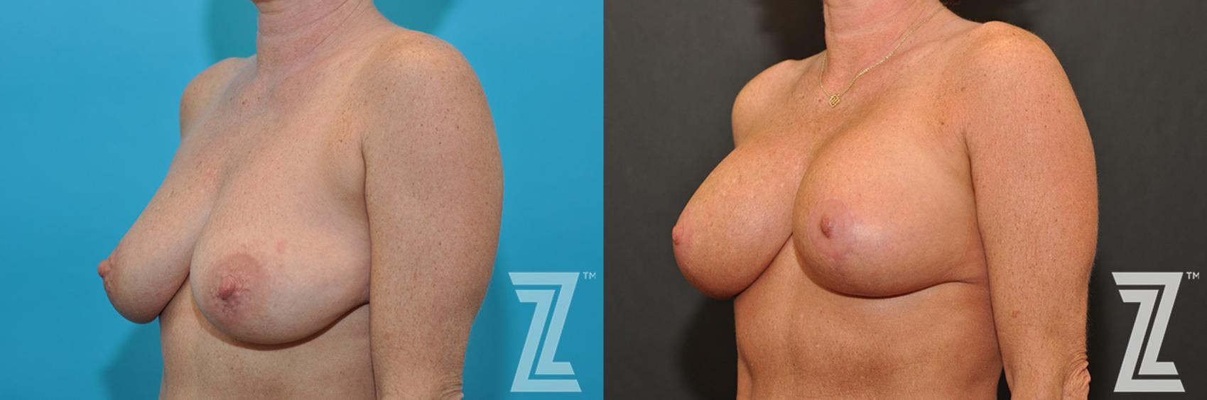 Breast Augmentation With a Breast Lift Before & After Gallery - Patient 132791107 - Image 2
