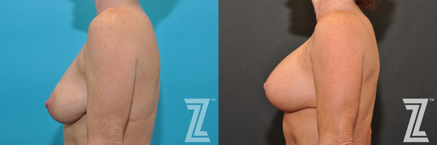 Breast Augmentation With a Breast Lift Before & After Gallery - Patient 132791107 - Image 3
