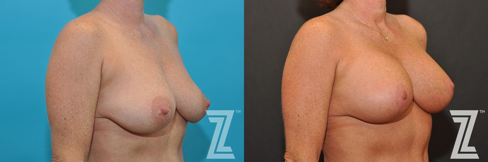 Breast Augmentation With a Breast Lift Before & After Gallery - Patient 132791107 - Image 4