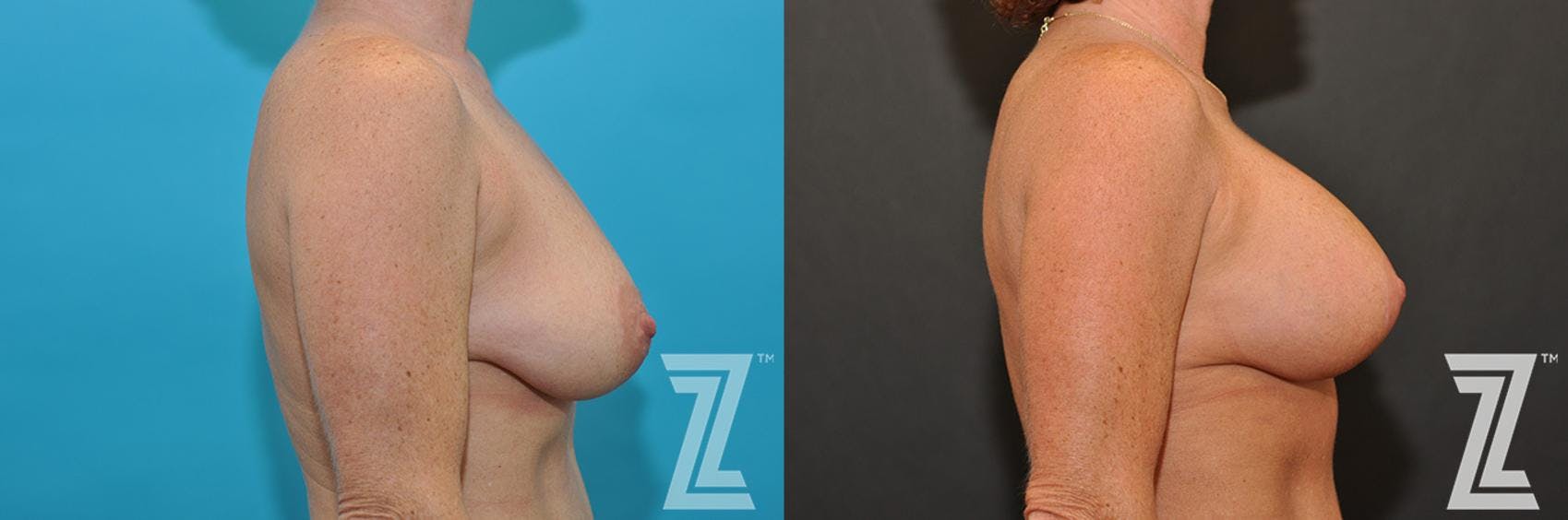 Breast Augmentation With a Breast Lift Before & After Gallery - Patient 132791107 - Image 5
