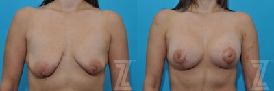 Breast Augmentation With a Breast Lift Before & After Gallery - Patient 132791109 - Image 1