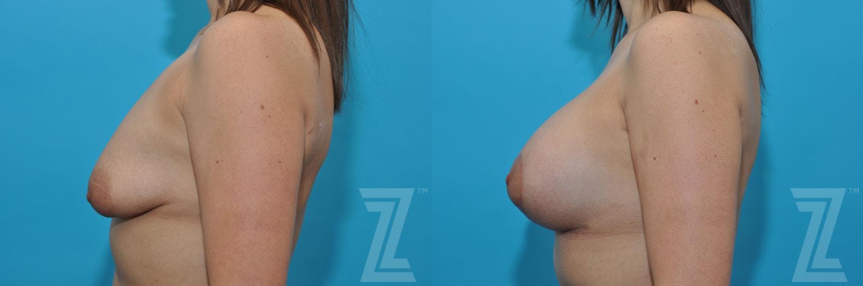 Breast Augmentation With a Breast Lift Before & After Gallery - Patient 132791109 - Image 4