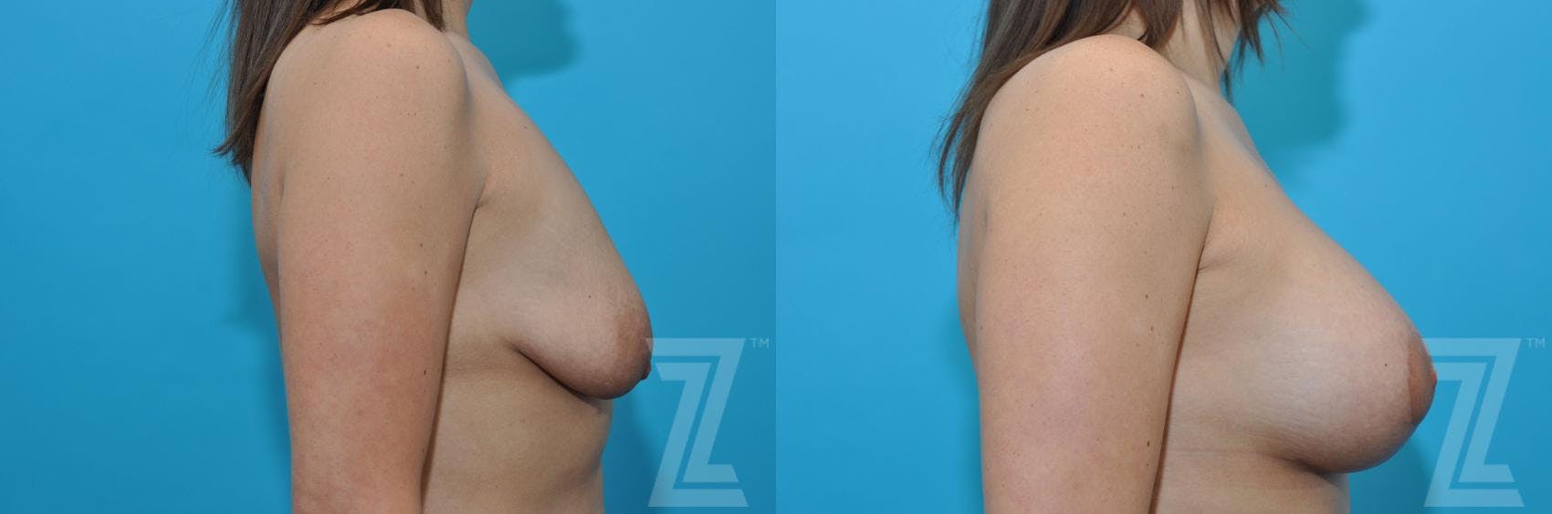 Breast Augmentation With a Breast Lift Before & After Gallery - Patient 132791109 - Image 6