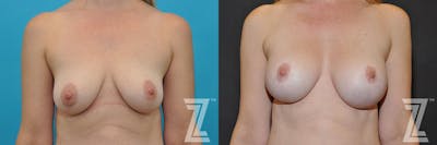 Austin Breast Augmentation With a Breast Lift Before & After Gallery - Patient 132791112 - Image 1 - The Piazza Center