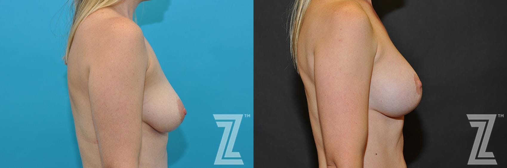Breast Augmentation With a Breast Lift Before & After Gallery - Patient 132791112 - Image 2
