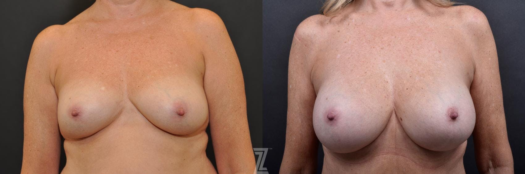 Breast Augmentation With a Breast Lift Before & After Gallery - Patient 132791113 - Image 1