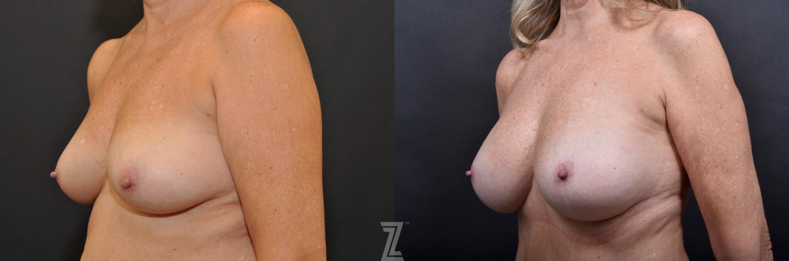 Austin Breast Augmentation With a Breast Lift Before & After Gallery - Patient 132791113 - Image 2 - The Piazza Center