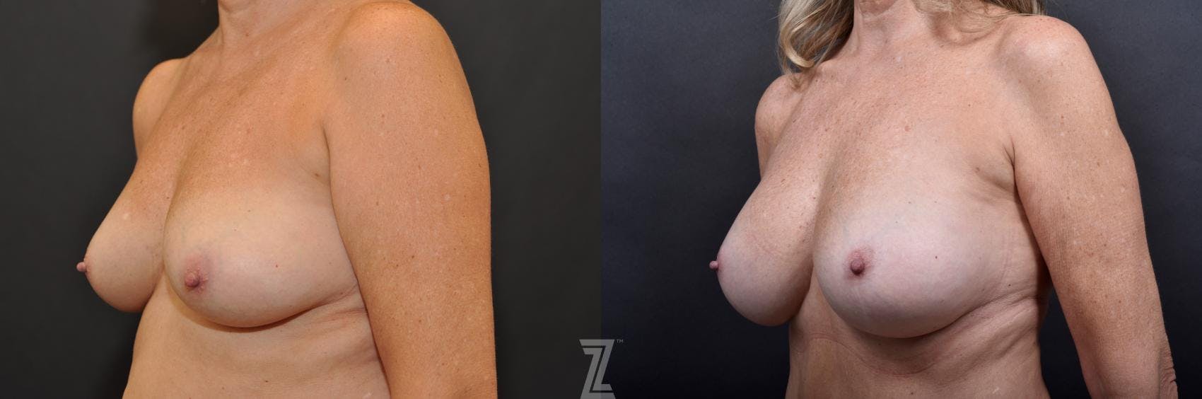 Breast Augmentation With a Breast Lift Before & After Gallery - Patient 132791113 - Image 2