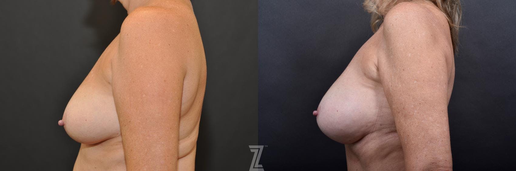 Breast Augmentation With a Breast Lift Before & After Gallery - Patient 132791113 - Image 3