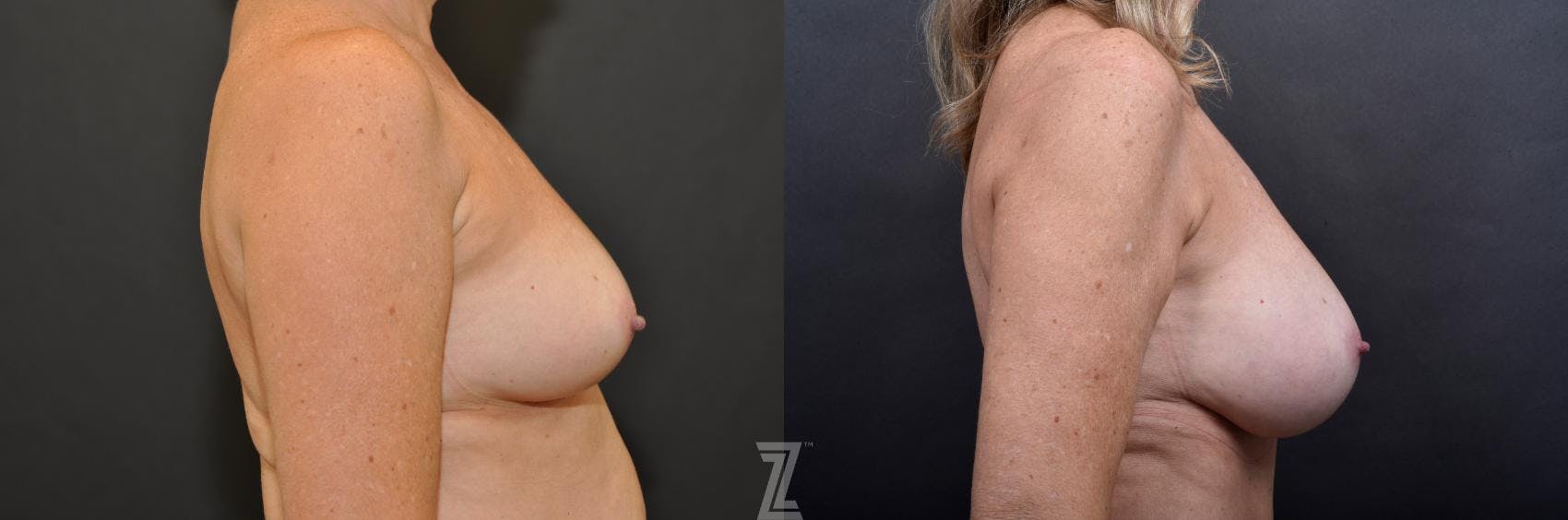 Breast Augmentation With a Breast Lift Before & After Gallery - Patient 132791113 - Image 5