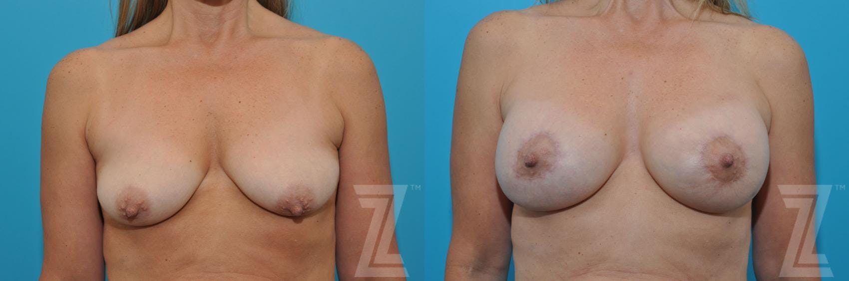 Breast Augmentation With a Breast Lift Before & After Gallery - Patient 132791122 - Image 1