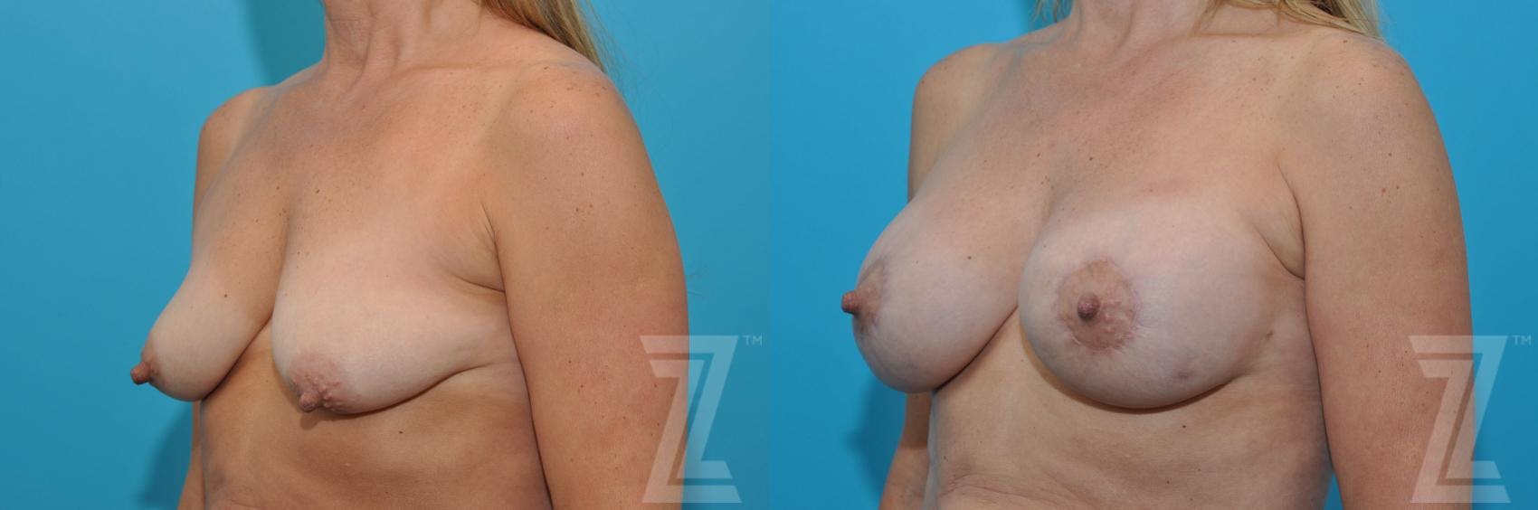Breast Augmentation With a Breast Lift Before & After Gallery - Patient 132791122 - Image 2