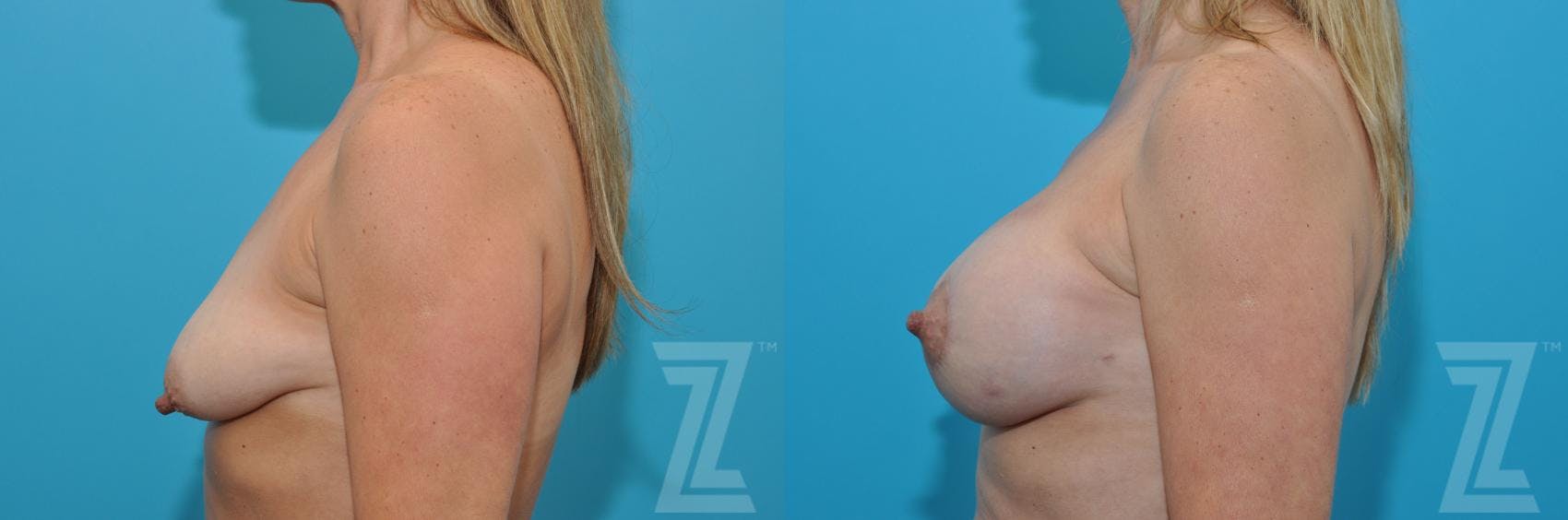 Breast Augmentation With a Breast Lift Before & After Gallery - Patient 132791122 - Image 3