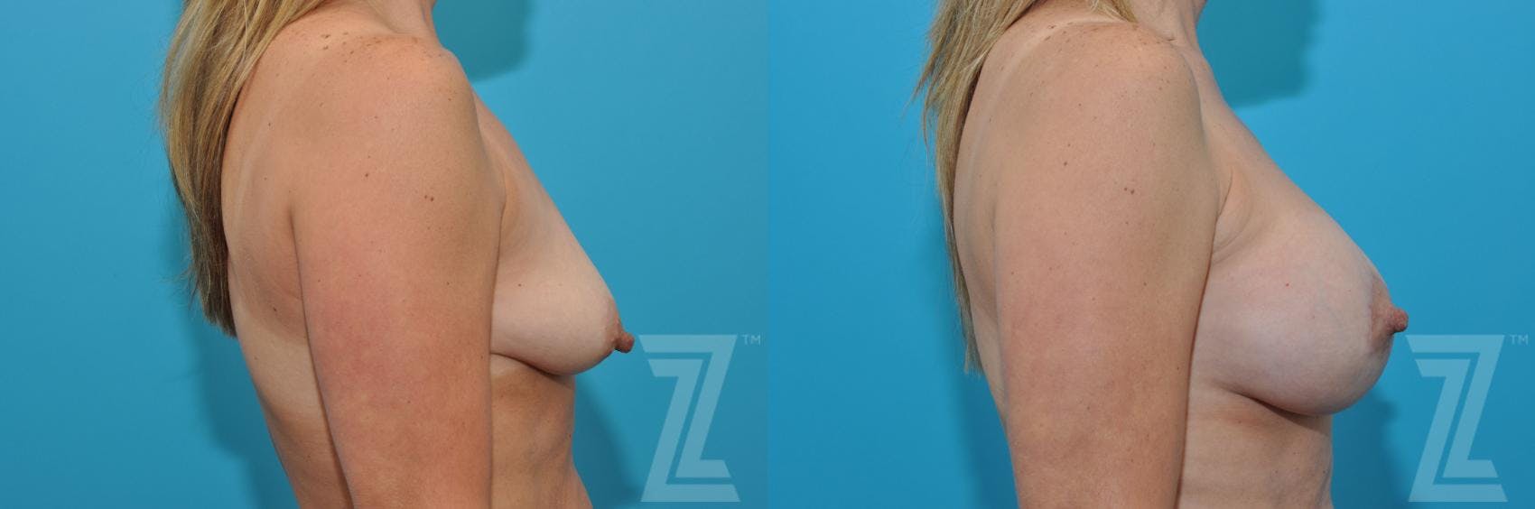 Breast Augmentation With a Breast Lift Before & After Gallery - Patient 132791122 - Image 5