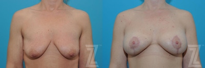 Breast Augmentation With a Breast Lift Before & After Gallery - Patient 132791127 - Image 1