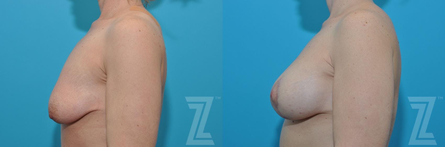 Breast Augmentation With a Breast Lift Before & After Gallery - Patient 132791127 - Image 3